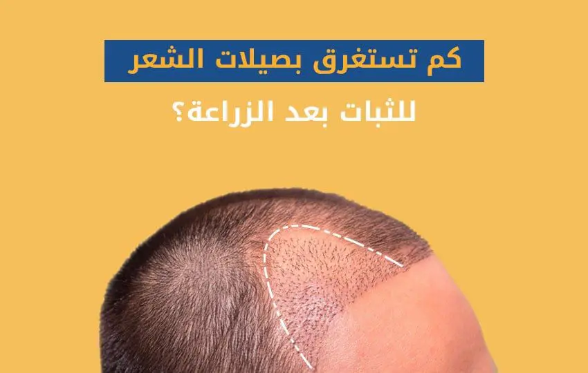 كم تستغرق بصيلات الشعر للثبات بعد الزراعة؟