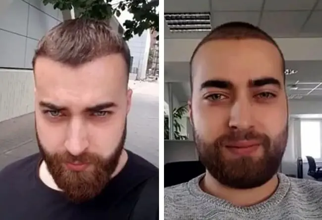 زراعة الشعر قبل وبعد 4 شهور فى تركيا فى مركز اليت هير