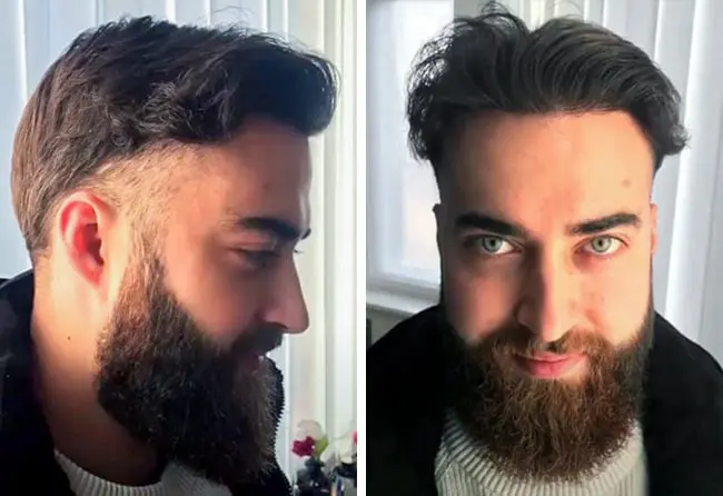 زراعة الشعر قبل وبعد 8 شهور فى تركيا فى مركز اليت هير