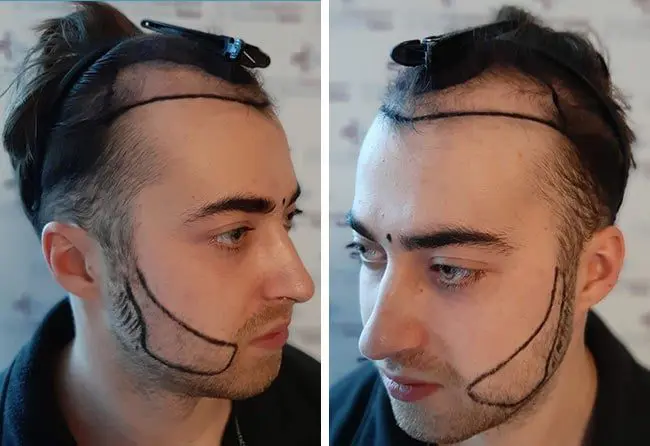 قبل زراعة الشعر فى مركز اليت هير