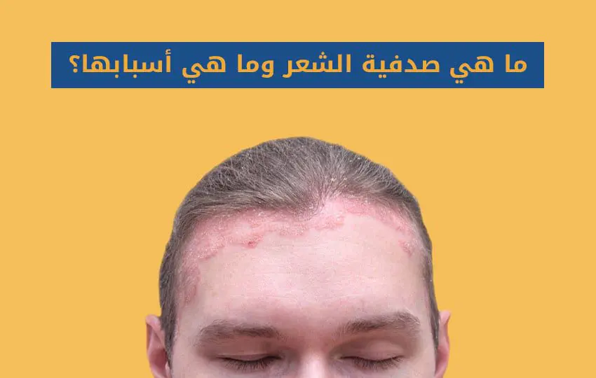 كل شيء عن صدفية الشعر من مركز اليت هير