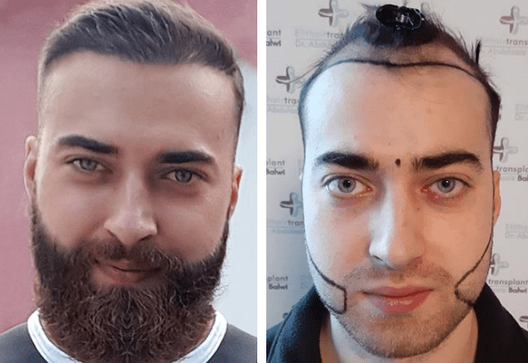 قبل وبعد زراعة الشعر في مركز اليت هير