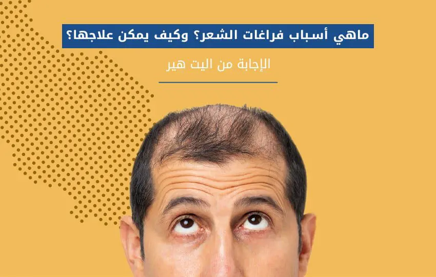 تجارب زراعة الشعر في مشفى اليت هير