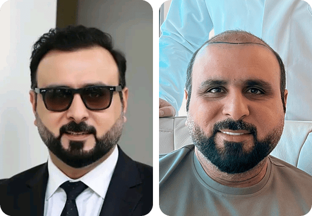 قبل وبعد زراعة الشعر في تركيا في مشفى اليت هير