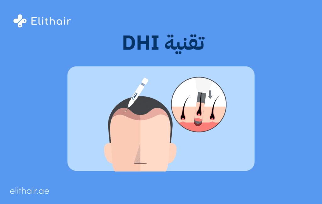 تقنية DHI - مركز اليت هير لزراعة الشعر