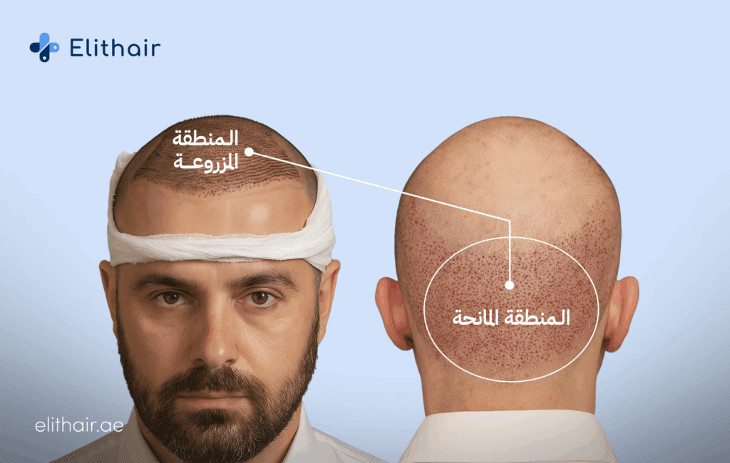 المنطقة المانحة والمزروعة - مركز اليت هير لزراعة الشعر