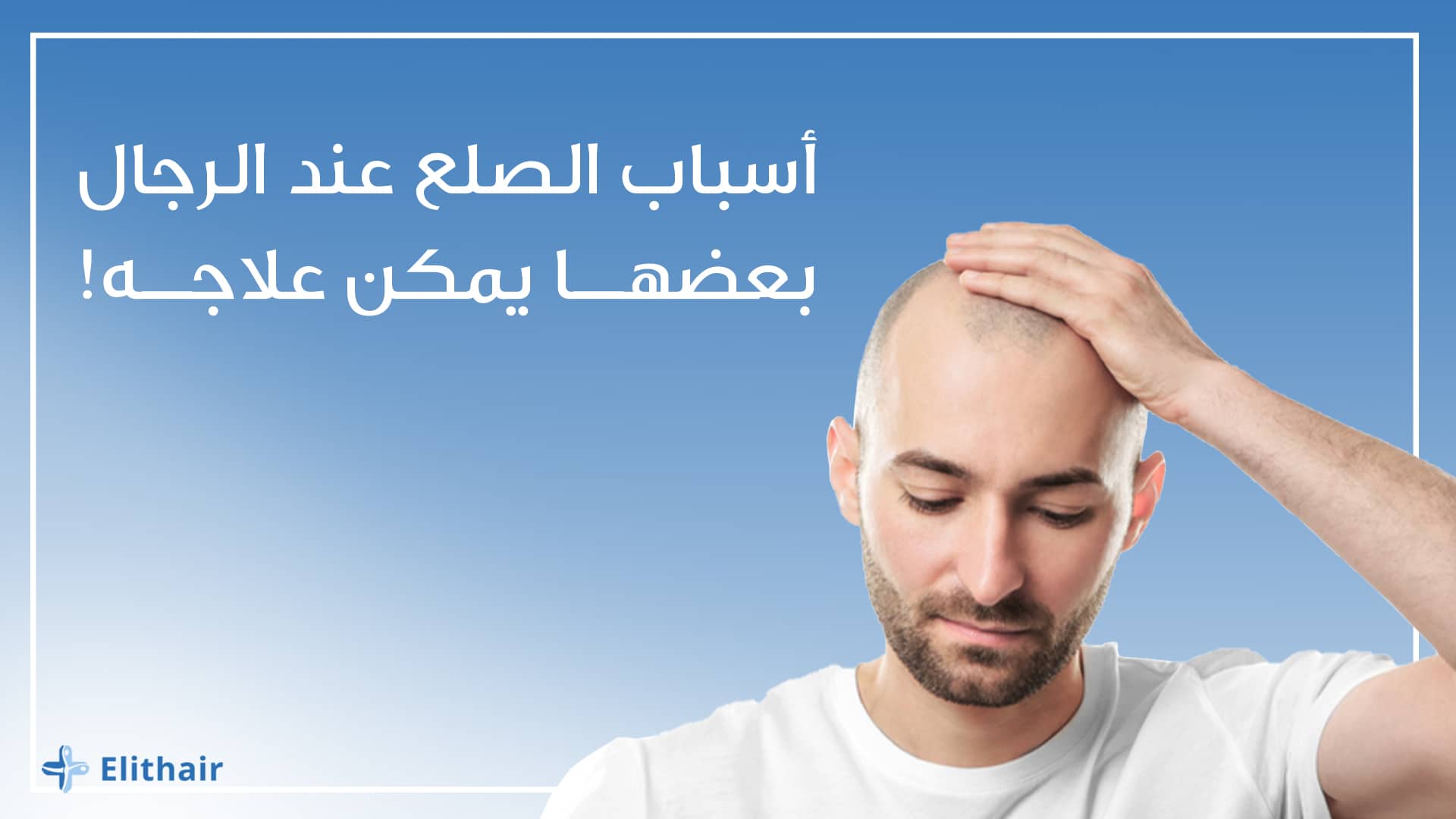 الصلع عند الرجال