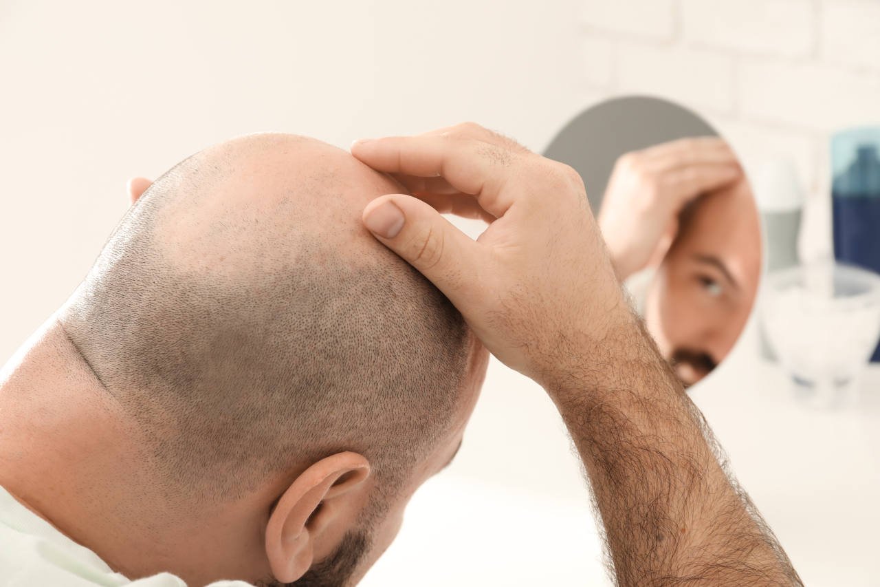 a man looking at his hair starting to bald