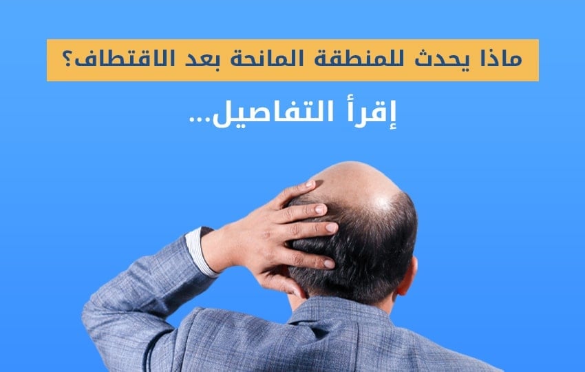 ماذا يحدث للمنطقة المانحة بعد زراعة الشعر؟