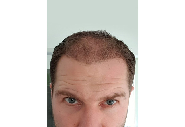 نتيجة عملية زراعة الشعر بعد 3 شهور في تركيا مركز اليت هير