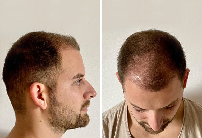 نتيجة عملية زراعة الشعر بعد ثلاث شهور في تركيا مركز اليت هير