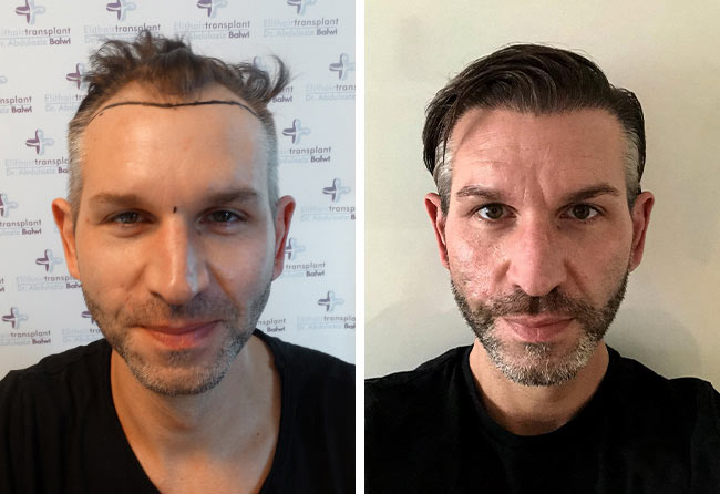 before after hair transplant sapphire fue 4250 grafts thomas schreier