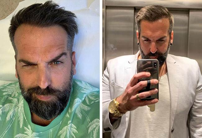 نتيجة عملية زراعة الشعر بعد 10 شهور للسيد يورغن في تركيا مركز اليت هير