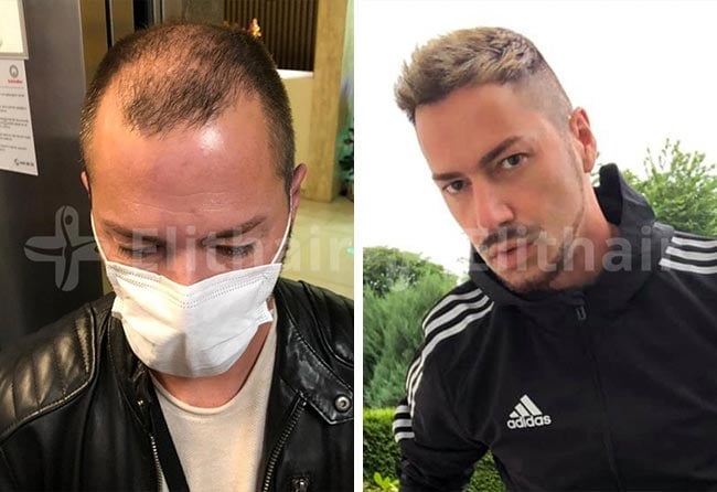 زراعة الشعر قبل وبعد فى تركيا بتقنية DHI