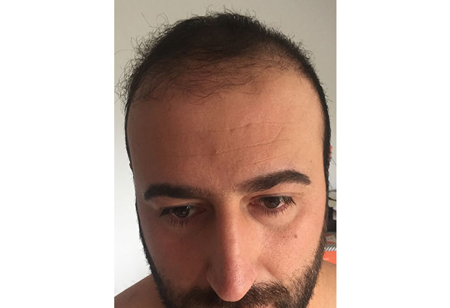 زراعة الشعر فى تركيا قبل وبعد 3 شهور | مركز اليت هير