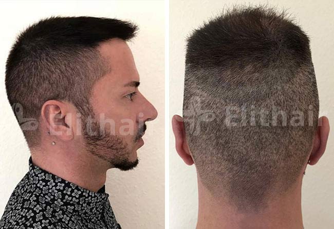 نتائج عملية زراعة الشعر فى تركيا بتقنية DHI