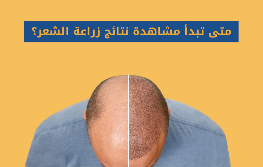 متى تظهر نتائج زراعة الشعر - مركز اليت هير لزراعة الشعر