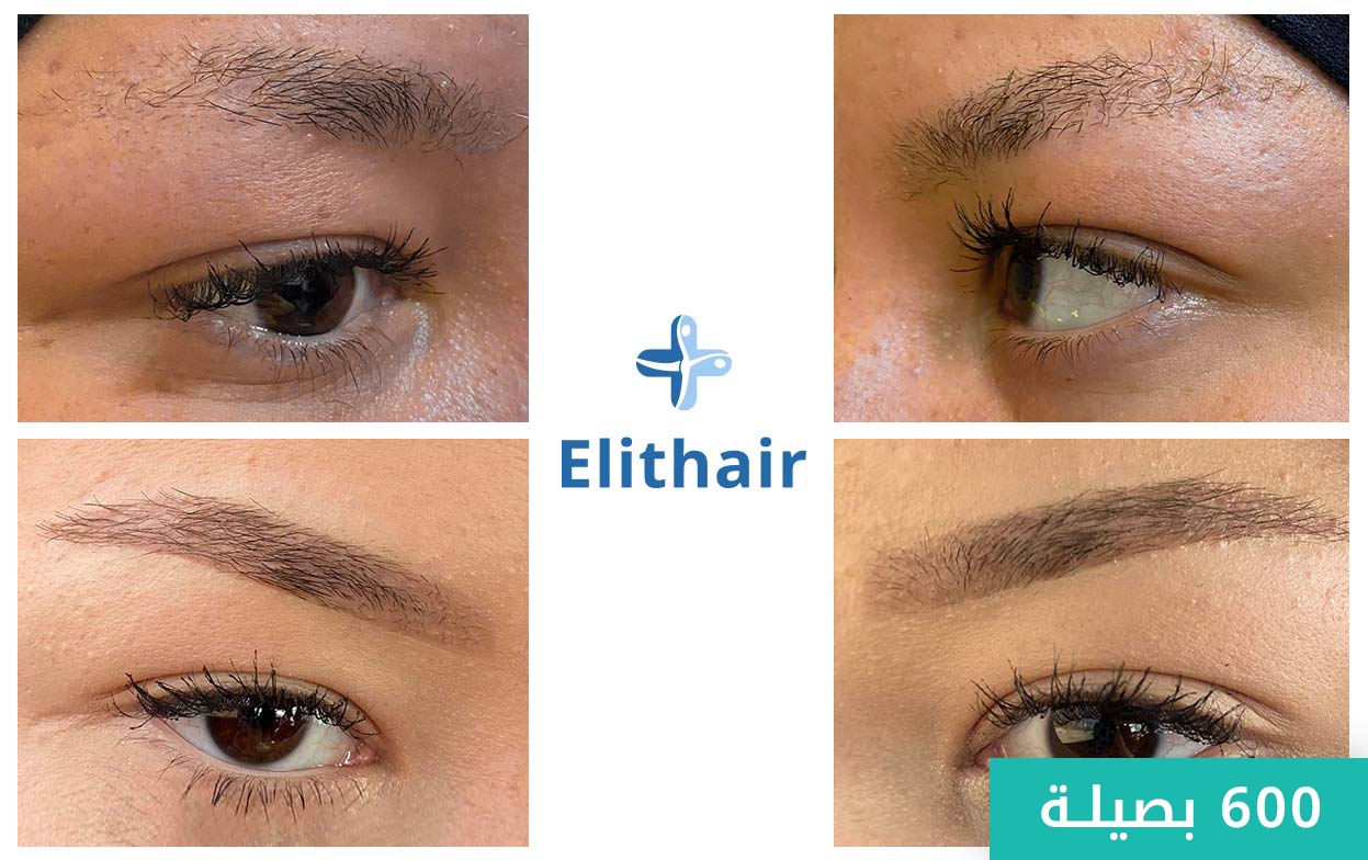 before after Liliana 2600 grafts A