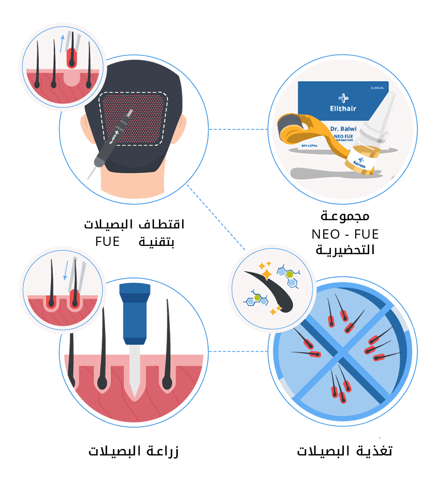 تقنية السفير لزراعة الشعر | مركز اليت هير