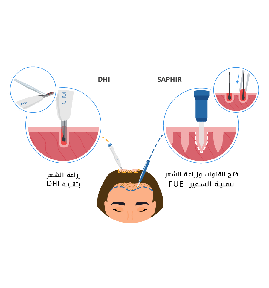 زراعة الشعر بتقنية SDHI | مركز اليت هير
