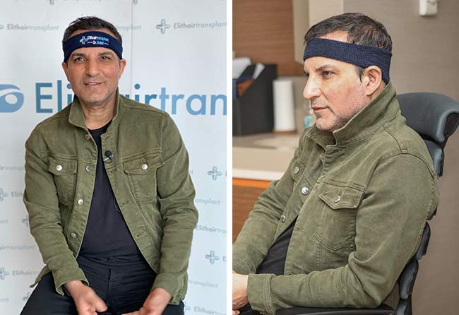 قبل زراعة الشعر في تركيا | مركز اليت هير