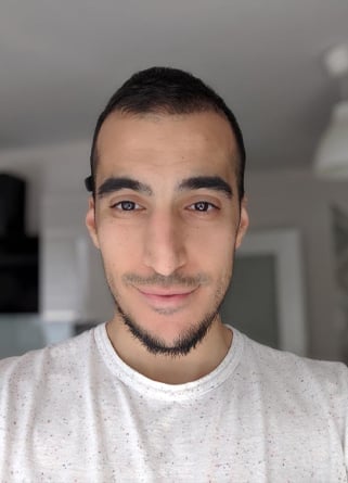 السيد عصام لعملية زراعة الشعر بمركز اليت هير بعد 5 أشهر