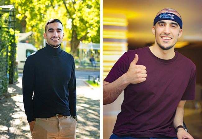 السيد عصام لعملية زراعة الشعر فى تركيا قبل وبعد بمركز اليت هير