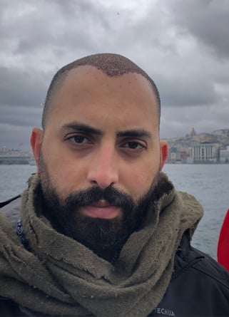 السيد مجد بعد عملية زراعة الشعر في إليت هير بيوم واحد