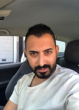 بعد عملية زراعة الشعر في اليت هير بـ 5 أشهر للسيد مجد