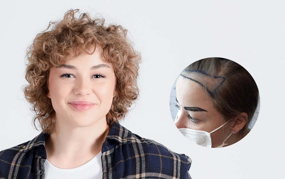 تكلفة زراعة الشعر للنساء في تركيا - مع خدمات شاملة | مركز اليت هير