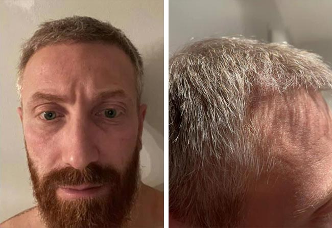 بعد 3 شهور عملية زراعة الشعر للسيد رفاييل مركز اليت هير