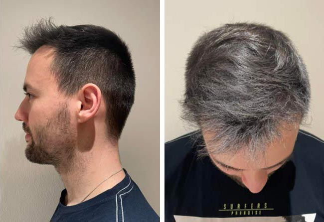 بعد 4 و 6 شهور عملية زراعة الشعر للسيد اليكسنرا | بمركز اليت هير