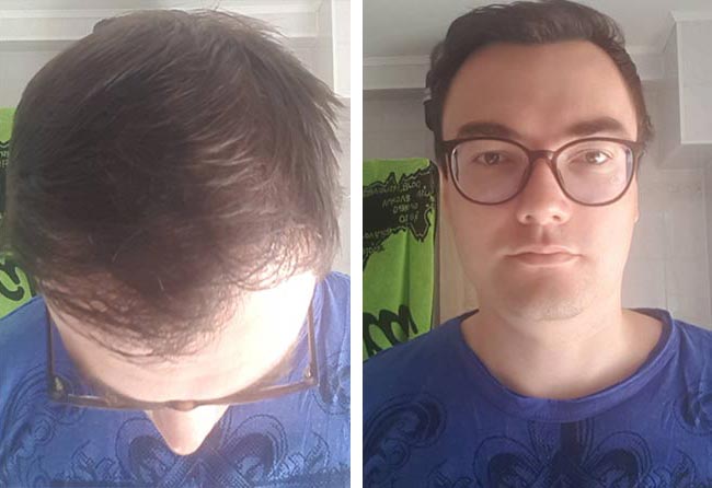 بعد 5 شهور عملية زراعة الشعر للسيد كريس | مركز إليت هير