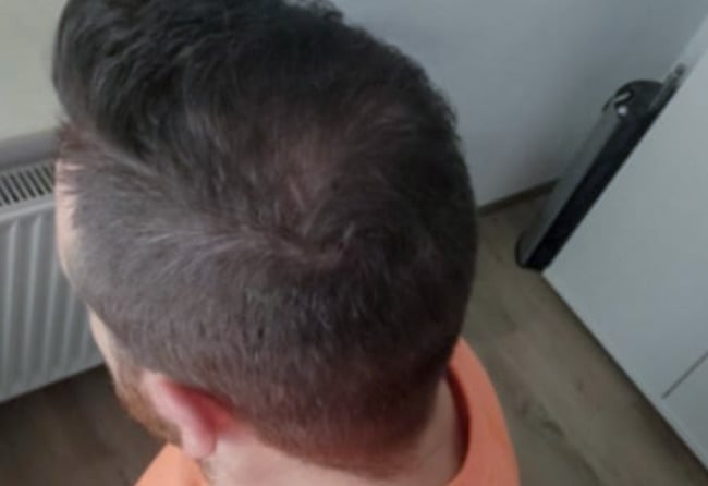 بعد زراعة شعر للسيد ثو | مركز اليت هير