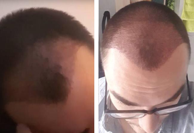 بعد شهر عملية زراعة الشعر للسيد كريس | مركز إليت هير