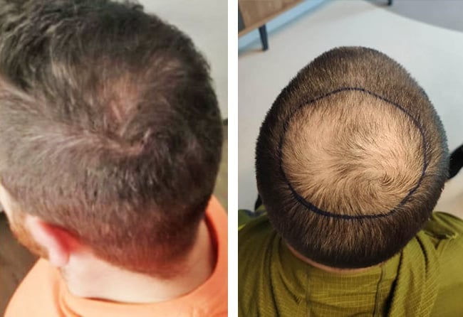 زراعة شعر قبل وبعد للسيد ثو | مركز اليت هير