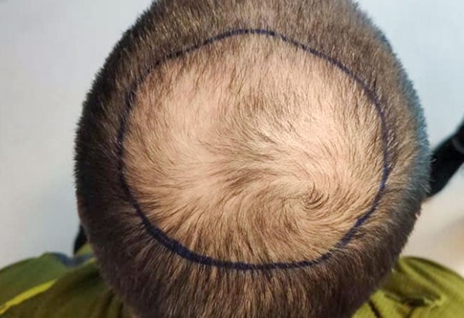 قبل زراعة شعر للسيد ثو | مركز اليت هير