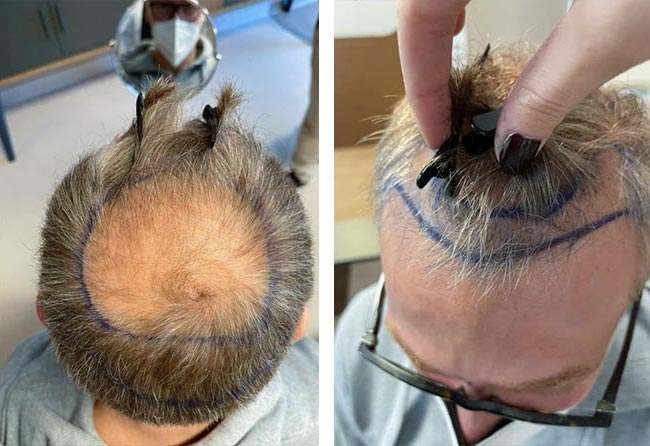قبل عملية زراعة الشعر للسيد رفاييل مركز اليت هير