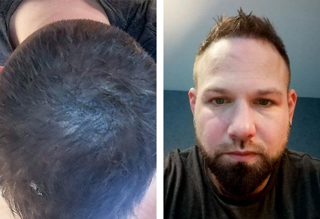 نتائج عملية زراعة الشعر للسيد باتريك مركز اليت هير