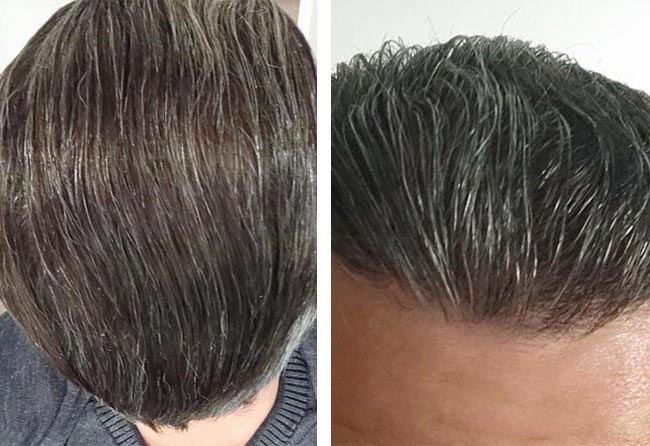 نتائج عملية زراعة الشعر للسيد داني مركز اليت هير