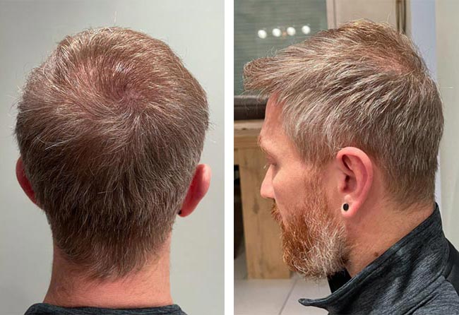 نتائج عملية زراعة الشعر للسيد رفاييل مركز اليت هير