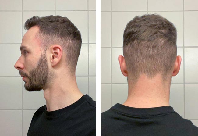 نتائج عملية زراعة الشعر للسيد كريس مركز اليت هير