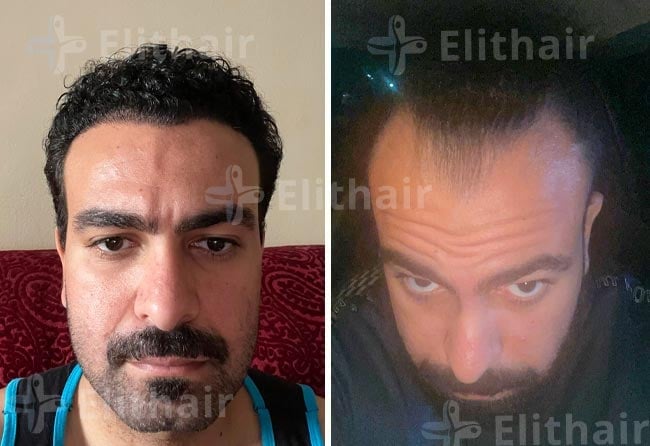 أحمد الغطاس قبل-وبعد-زراعة-الشعر-في-مركز-اليت-هير.jpg