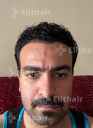 أحمد الغطاس-نتائج-زراعة-الشعر-في-مركز-اليت-هير