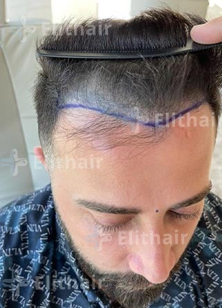 الفنان عبد الكريم حمدان قبل-زراعة-الشعر-في-مركز-اليت-هير