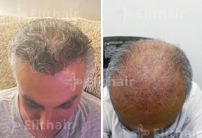 حسام النكدلي-قبل-وبعد-زراعة-الشعر-في-مركز-اليت-هير