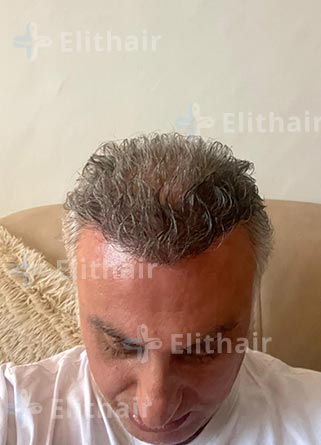 زراعة شعر في تركيا بمركز اليت هير