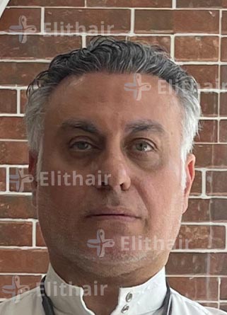 زرع شعر بمركز اليت هير