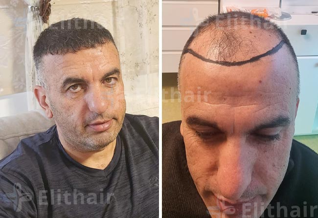 سعيد منصور-قبل-وبعد-زراعة-الشعر-في-مركز-اليت-هير