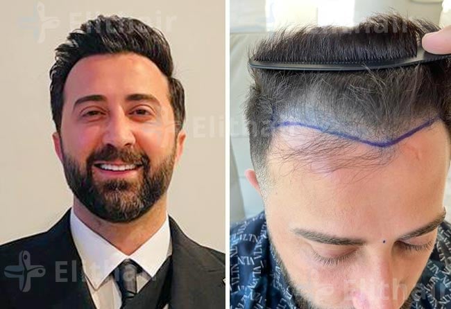 عبد الكريم حمدان قبل-وبعد-زراعة-الشعر-في-مركز-اليت-هير